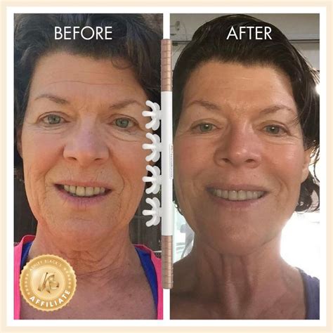 fascia blasting before and after face|fascia blaster does it work.